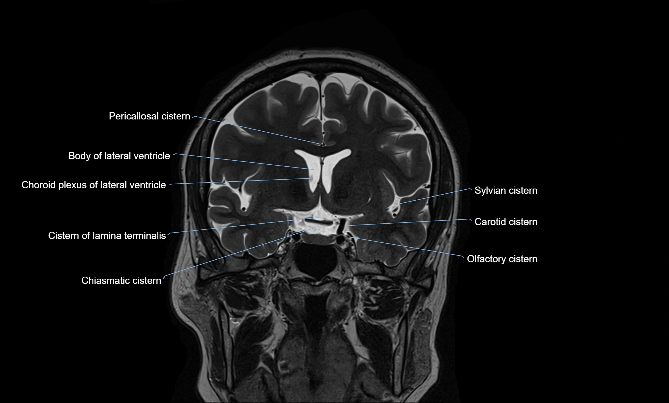 Brain cisterns  and ventricles coronal anatomy 3T MRI image-img-00001-00022.webp